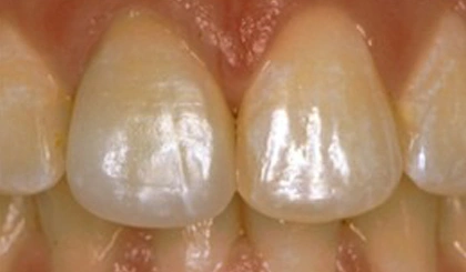 Close-up of upper front teeth showing dental work and natural tooth structure in clinical setting.