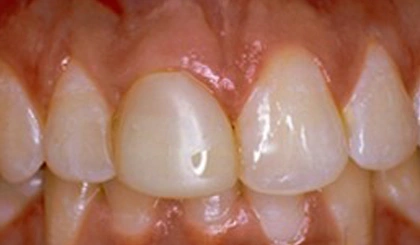 Close-up of upper front teeth showing dental work and natural tooth structure in clinical setting.