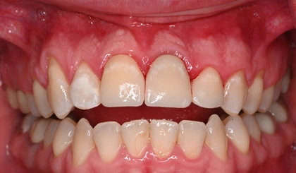 Close-up view of aligned upper and lower teeth showing dental health and bite alignment.