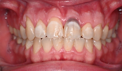Close-up of upper and lower teeth showing dental alignment and tooth color during oral examination.