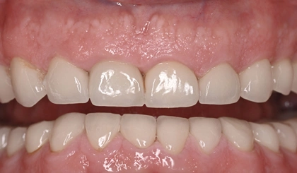 Close-up of upper front teeth showing dental crowns on central incisors against pink gum tissue.