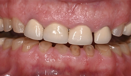 Close-up of upper front teeth showing dental crowns and restorations in a clinical setting.