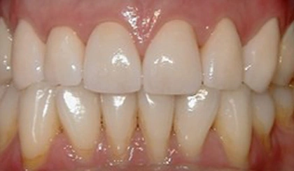 Close-up of natural-looking dental work showing upper and lower teeth with proper alignment and white restoration.