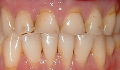 Close-up of healthy upper and lower teeth showing natural tooth color and alignment in dental setting.