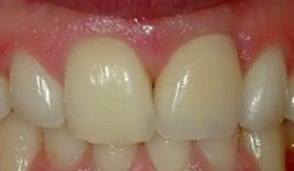 After cosmetic dental treatment, patient's upper front teeth display a bright, natural-looking smile.