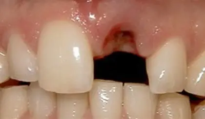 Before dental treatment showing missing front tooth with adjacent teeth visible.