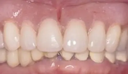After cosmetic dental treatment showing natural-looking front teeth alignment and whitening results.