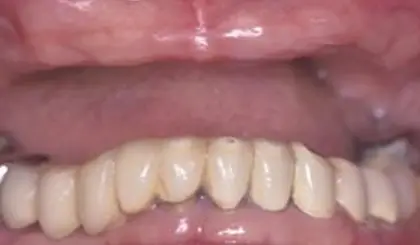 Before dental restoration showing discolored and worn upper teeth requiring cosmetic treatment.
