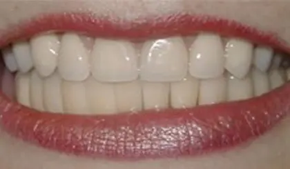 After smile makeover showing bright, evenly aligned white teeth with natural appearance.