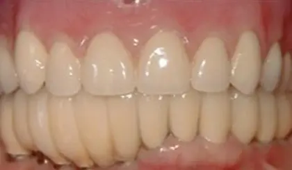 Before and after dental veneers showing improved tooth shape and alignment in Mesa.
