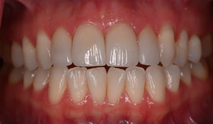 Close-up of aligned upper and lower teeth showing whitened dental work and healthy gums.