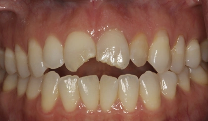 Close-up view of upper and lower teeth showing dental alignment and bite relationship.