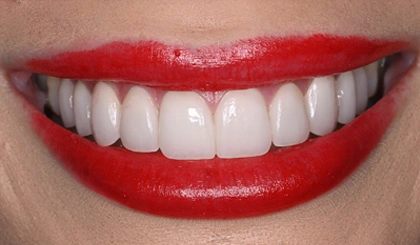 Close-up of bright white teeth with red lipstick smile showing dental care results.