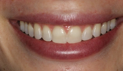 Close-up of a person's smile displaying bright, evenly-aligned white teeth and healthy gums.