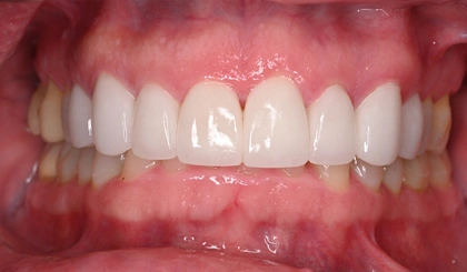 Close-up of bright white dental veneers on upper front teeth in a smile.