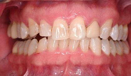 Close-up of patient's teeth showing dental alignment and oral health condition.