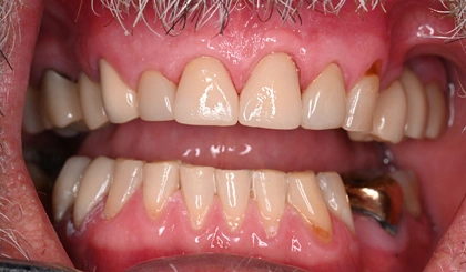 Close-up of open mouth showing upper and lower teeth with natural coloring and dental work.