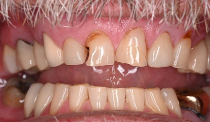 Close-up of natural-looking dental veneers or crowns showing upper and lower teeth alignment and aesthetic restoration.