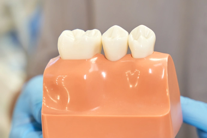 Three dental crowns displayed on orange dental model demonstrating restorative dentistry procedures.
