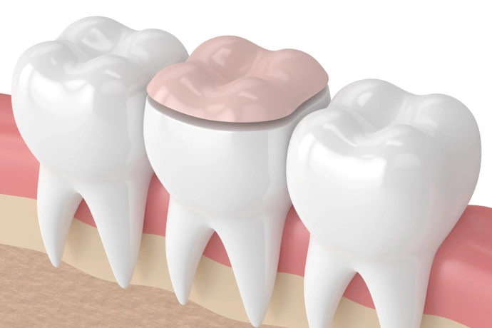 Three white teeth with pink gums, center tooth has brown crown restoration.