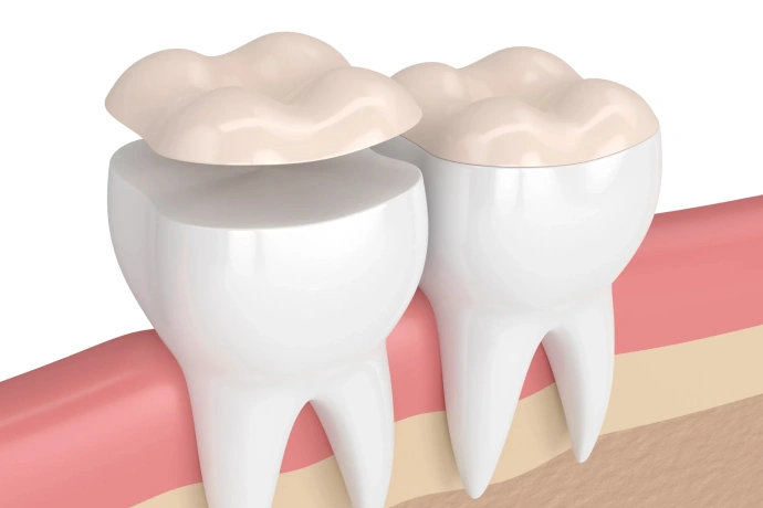 Two dental crowns on teeth with gum and bone illustration for restorative dentistry.
