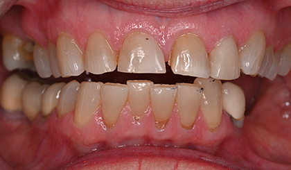 Close-up view of upper and lower teeth showing dental work and tooth coloration during examination.