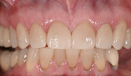 Close-up view of upper and lower teeth showing dental alignment and tooth color during oral examination.