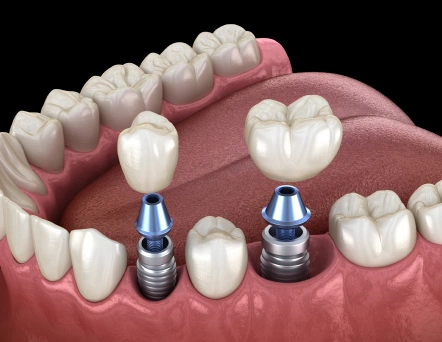 Dental implants illustration showing two titanium implant posts in jawbone with prosthetic crowns.