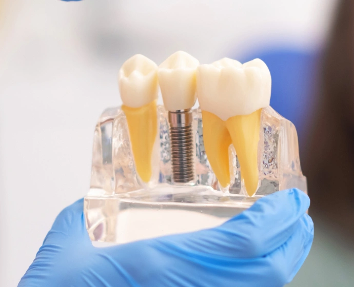 Dental professional in blue gloves holding model displaying dental implant components and tooth replacements.