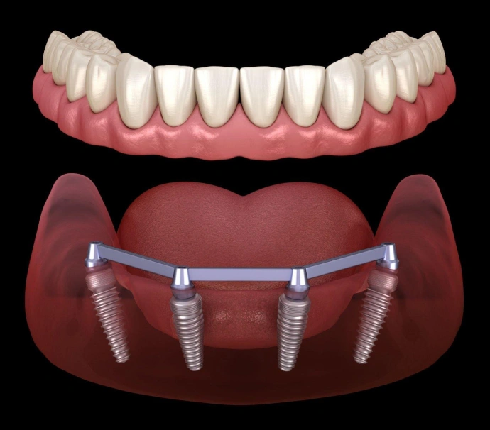 Dental implant prosthetic showing artificial teeth above gum model with four implant posts below.