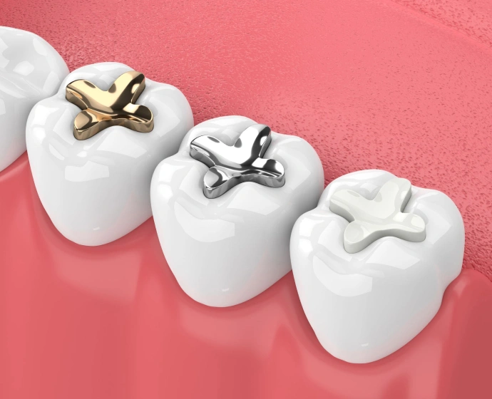 Three white tooth models on pink background, displaying gold and silver dental crowns and restorations.