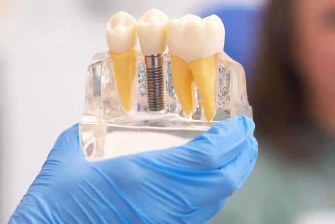 Dentist in blue gloves holds dental implant model showing tooth and metal implant components.