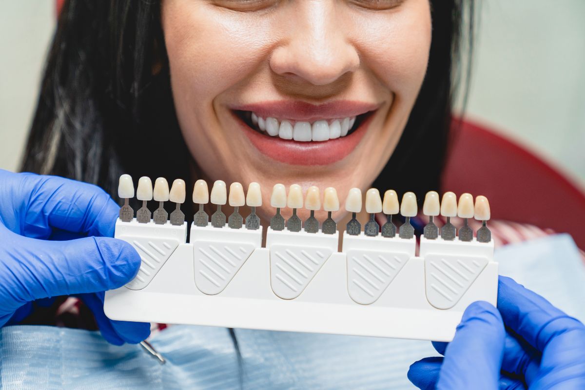 porcelain veneers mesa