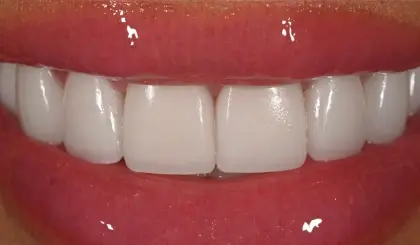 After smile makeover showing bright white front teeth with natural appearance and healthy gums.