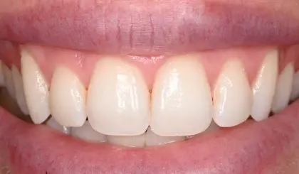 Close-up of patient's bright white smile showing naturally aligned upper front teeth after dental treatment.