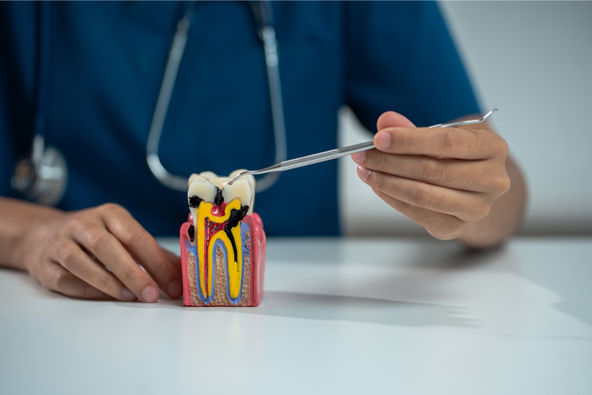 Removing A Nerve From A Tooth A Mesa Dentist's Guide