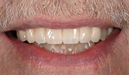 Close-up of a person's smile showing upper teeth with dental work and natural gum line.