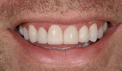 Close-up of a man's smile displaying white, even dental veneers or crowns