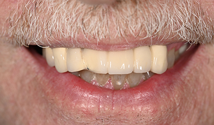 Close-up of a person's smile showing dental work with upper teeth veneers or crowns.