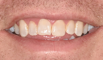 Close-up of a person's smile showing upper front teeth with natural appearance and healthy gums.