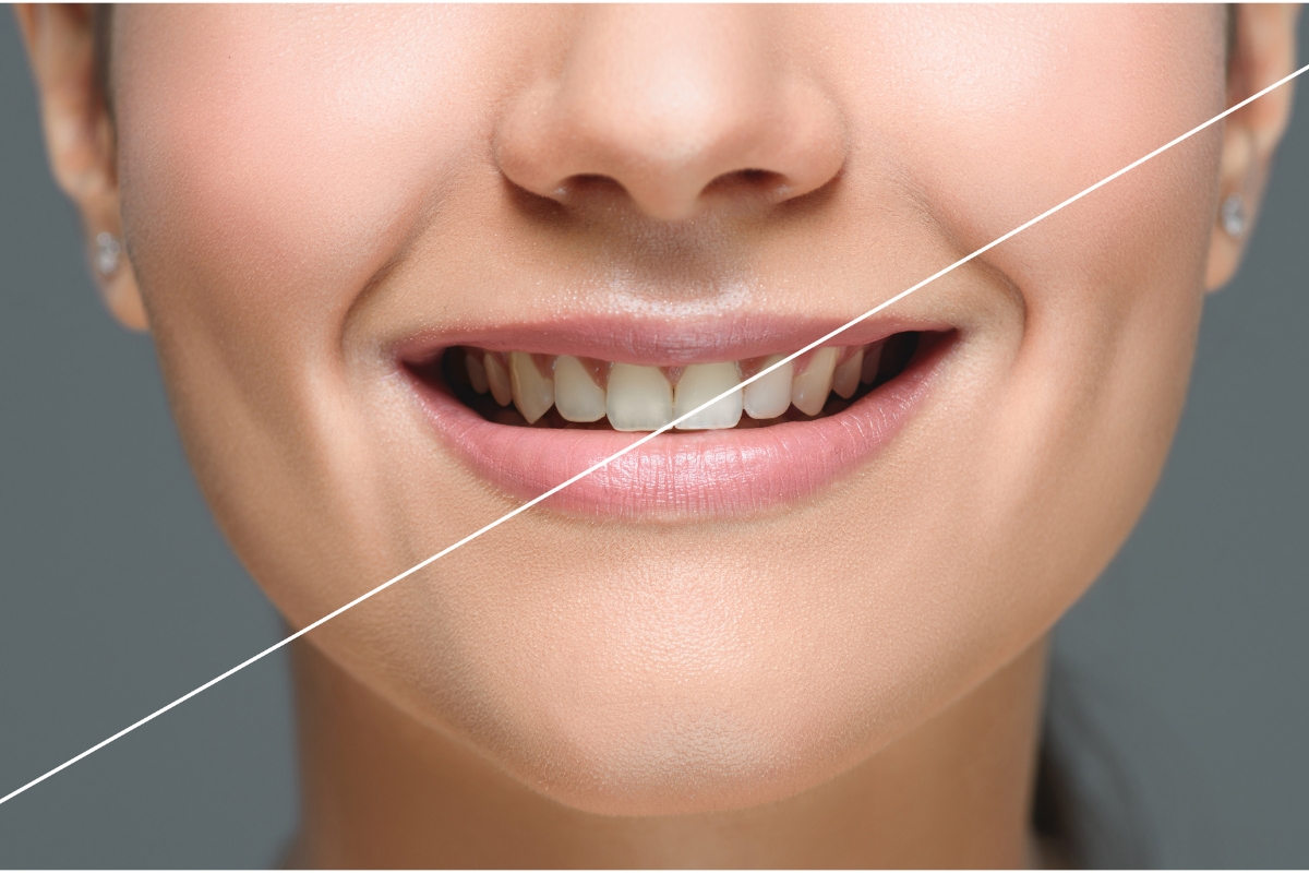 Homemade Teeth Whitening Solutions That Actually Work for Mesa People