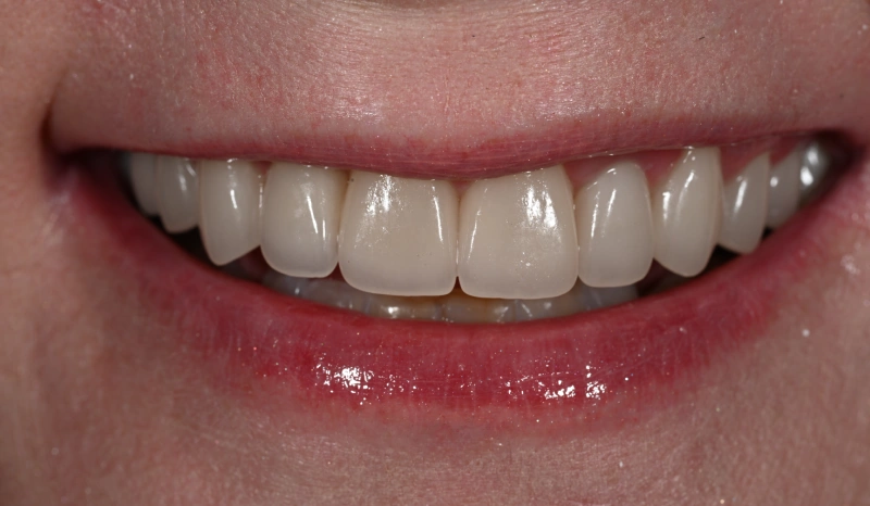 Close-up of a patient's smile showing bright, straight white teeth and healthy gums.