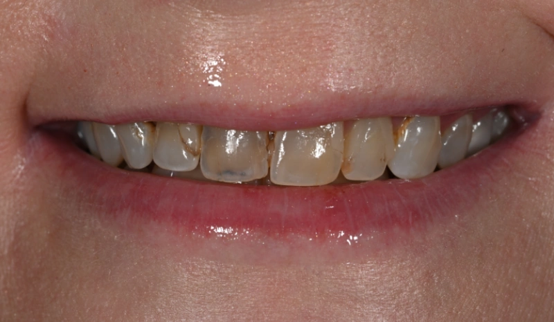 Close-up of discolored upper teeth showing staining and discoloration requiring dental treatment.