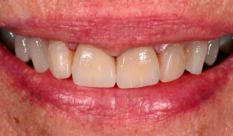Close-up of upper front teeth showing discoloration and wear, dental concern example.