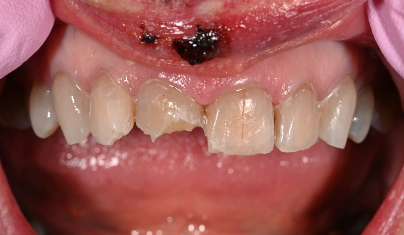Close-up of upper front teeth showing discoloration and dental issues requiring professional treatment