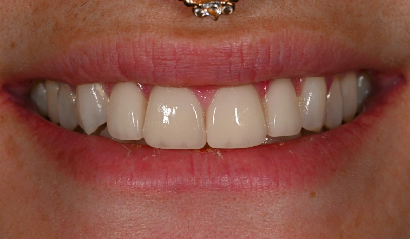 Close-up of a person's smile showing bright white teeth and natural lips, dental showcase.