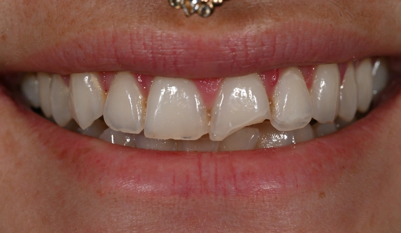 Close-up of upper front teeth showing dental work and natural tooth coloring variations.